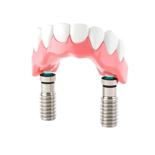 3D illustration of Implant-Supported Denture
